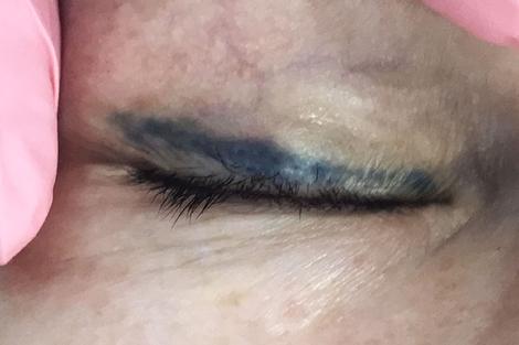 Блог про удаление перманентного макияжа тату ремувером