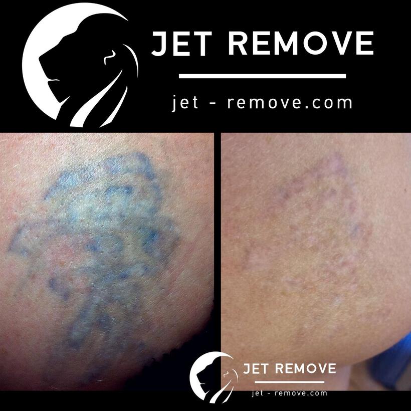 Tattoo remover Jet Remove. Permanent makeup  and tattoo removal.