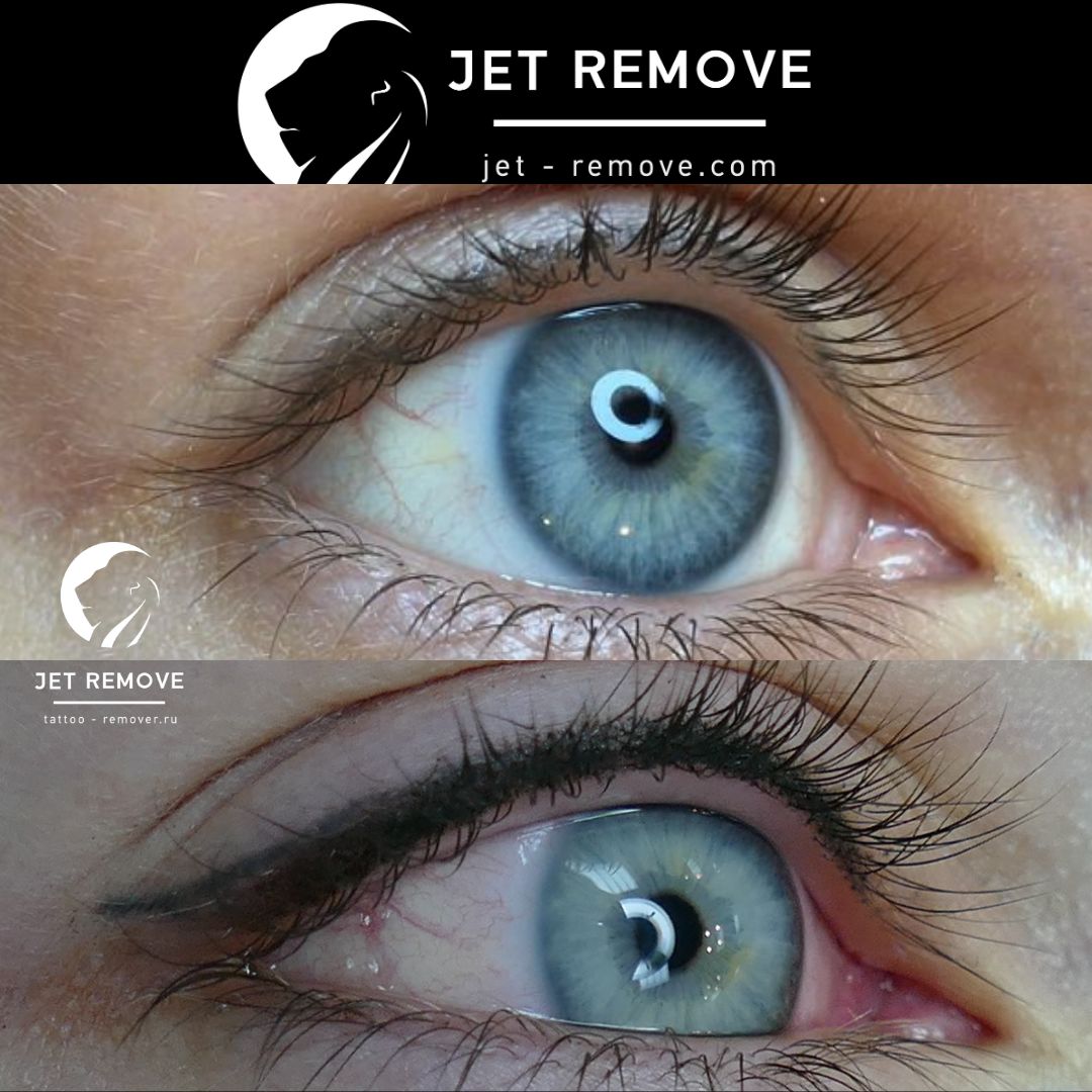 Eyeliner Tattoo Removal  How to Remove Permanent Eyeliner